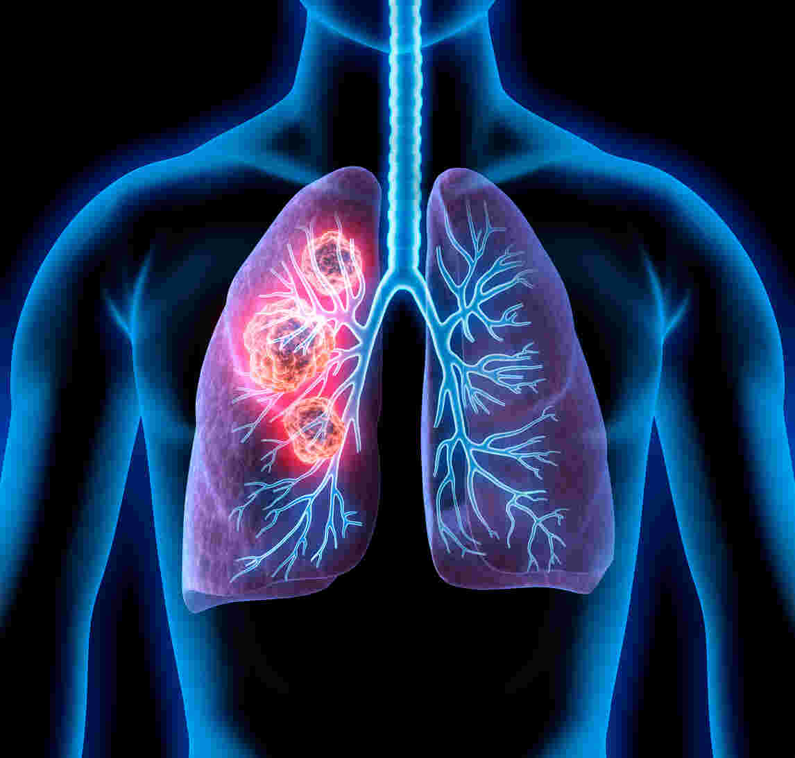 lung cancer